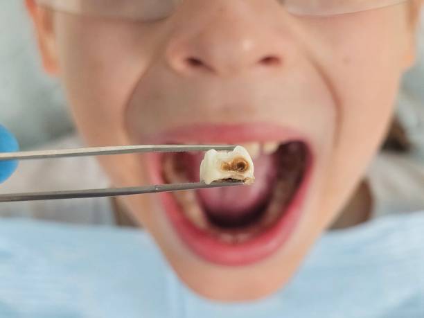 Best Emergency Tooth Extraction in Lawrenceville, VA